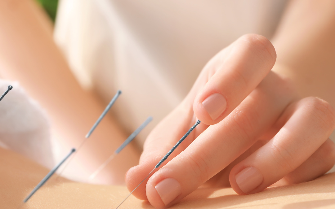 3 schorzenia, w których pomóc może akupunktura